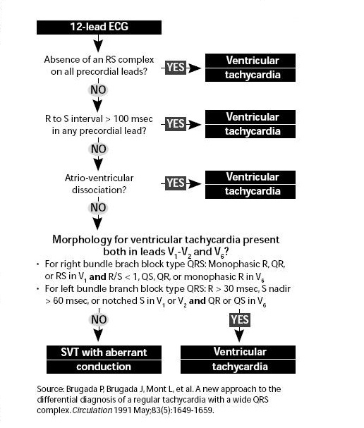 ::햇빛의료판례:: > 용어사전 > 빠른맥(빈맥)의 구별 ; Differential diagnosis of tachycardia